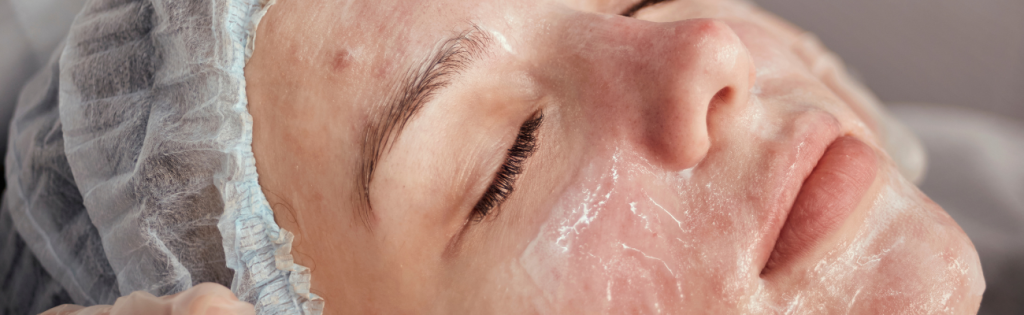 Aesthetic Clinics and Acne Treatment: From Topical Solutions to Laser Therapy 4 BLOGS 2023 03 22T233022.603