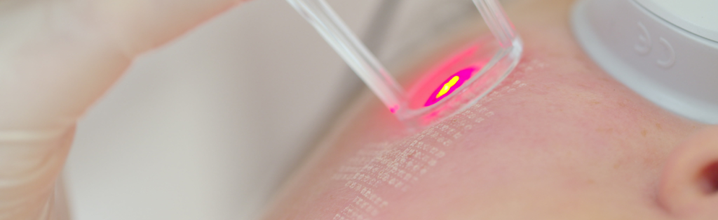 Decoding the Mysteries of Aesthetic Clinics: Med Spas, Dermatology Centres, and Beyond! 2 Client receiving laser treatment on the face in a professional aesthetic clinic.