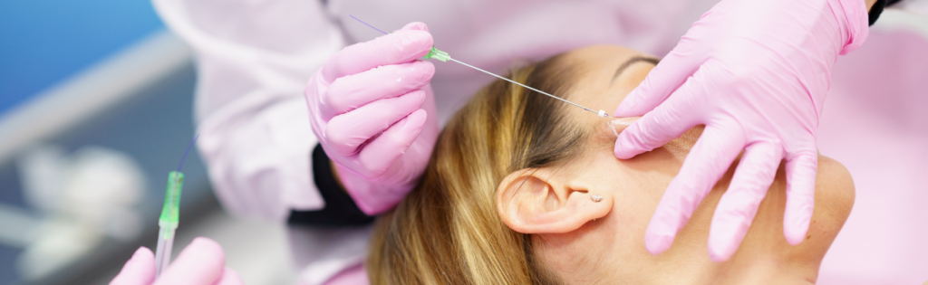 Woman receiving PDO thread treatment for facial lifting in a clinical setting.