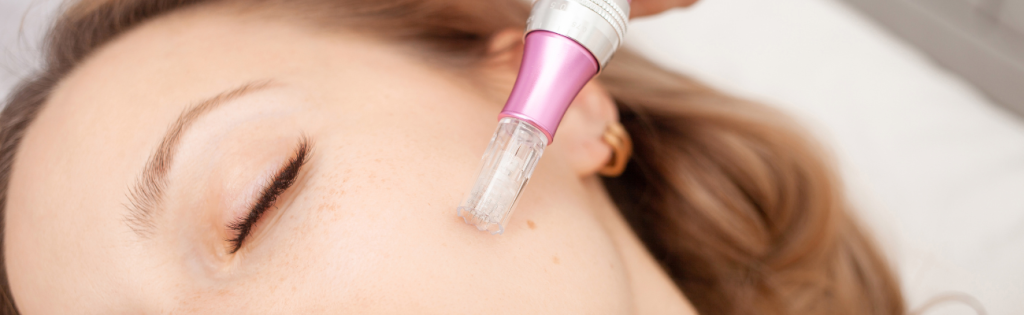 Faces | Summer-Ready Skin with Microneedling 2 Close-up of woman undergoing microneedling for skin rejuvenation.