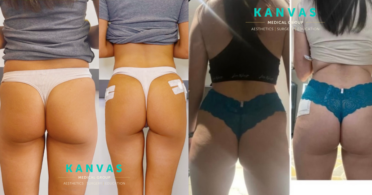 The Complete Guide on the Most Popular Aesthetic Treatments this 2024! 3 liquid bbl aesthetics treatment before and after.