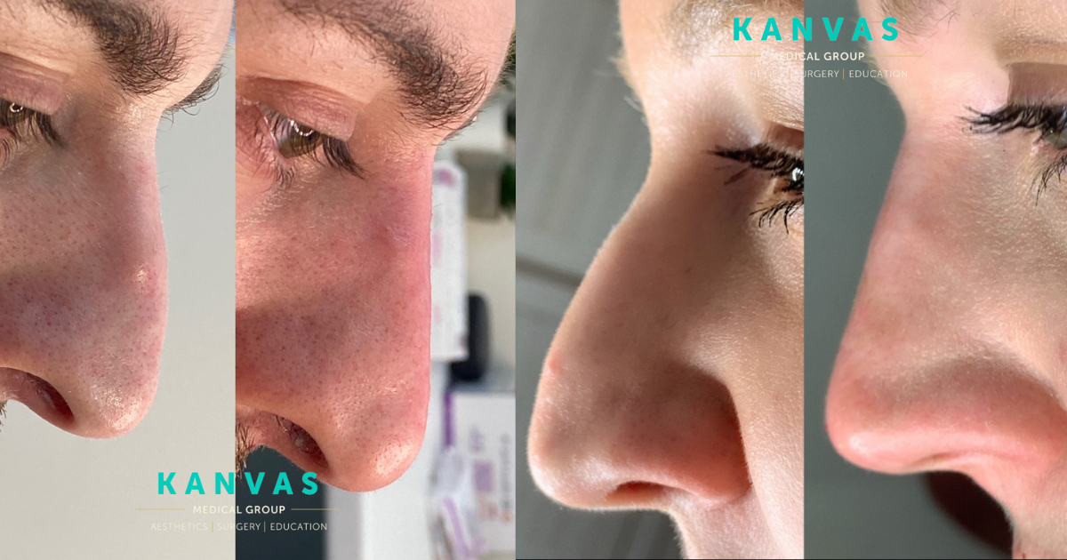 The Complete Guide on the Most Popular Aesthetic Treatments this 2024! 2 non-surgical rhinoplasty before and after results.
