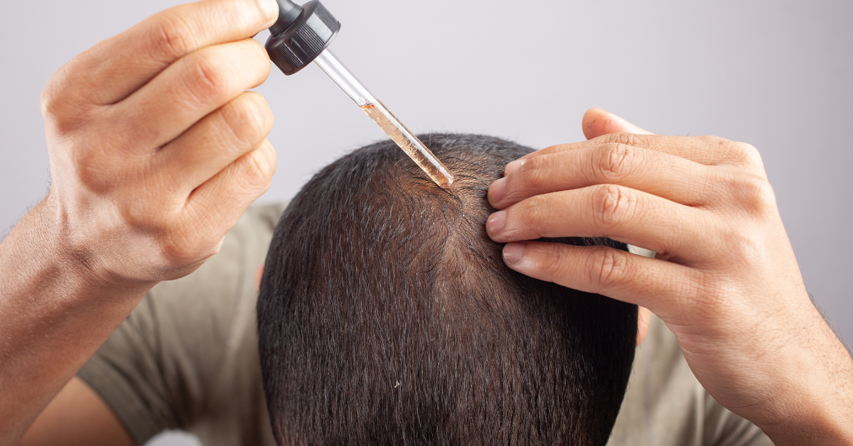 Finasteride and Minoxidil: A Powerful Solution To Male Hair Loss 1 finasteride and minoxidil topical solution